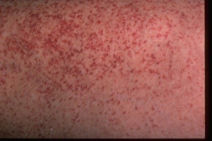 Sandsynligvis by marked Tiny Red Dots On Skin - TSMP Medical Blog
