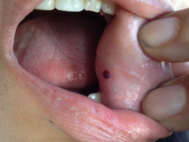dyr reservation Theseus What Causes Blood Blister to Occur in Mouth? What to Do? - TSMP Medical Blog