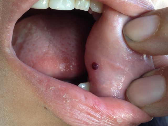 blood blister in mouth