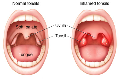 Medicine for Tonsillitis