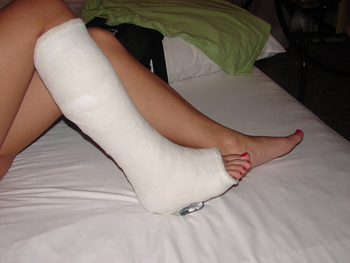Ankle Avulsion Fracture Treatments and Rehabilitation