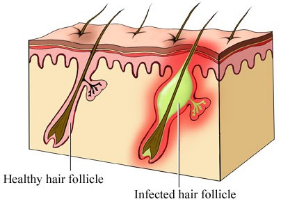 Bacterial skin infections Folliculitis and furunculosis  DermNet