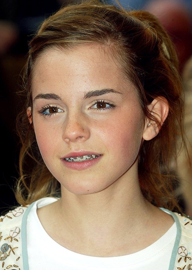 Celebrities with Braces - TSMP Medical Blog