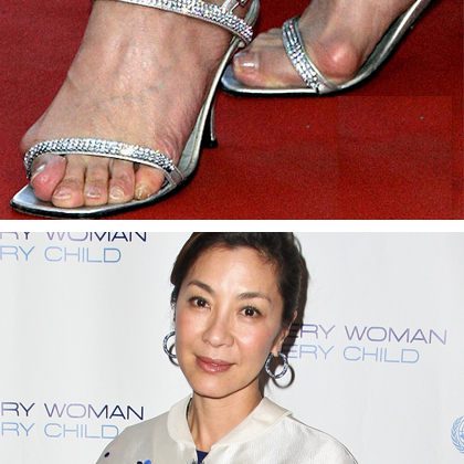 Pretty Celebrities With Bunions