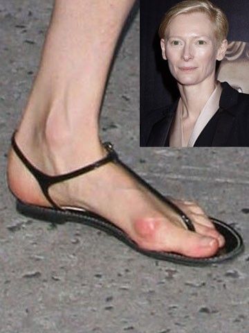 Pretty Celebrities With Bunions