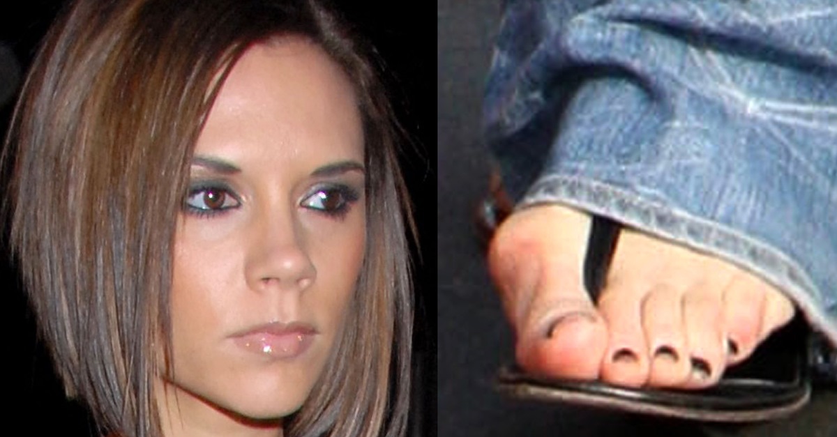 Pretty Celebrities With Bunions