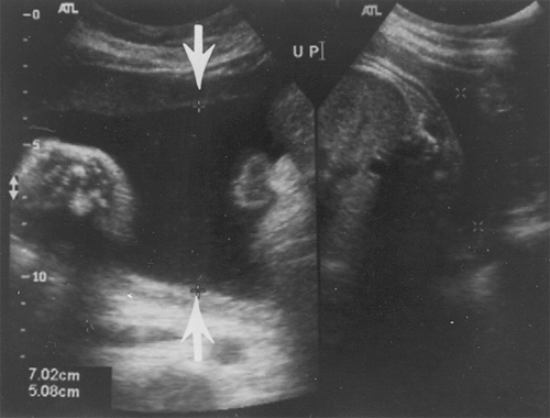 amniotic fluid index amniotic fluid index
