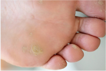5 Major Foot Bumps And How To Deal With Them New Health Advisor