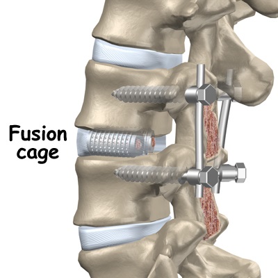 Spinal Fusion Recovery