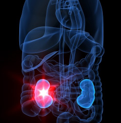 Kidney Transplant Rejection