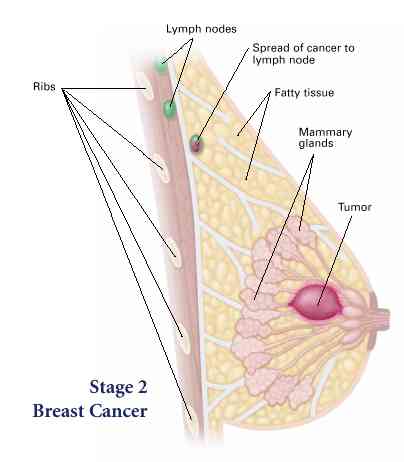 Stage 2 Breast Cancer
