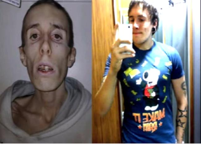 Anorexia Before and After