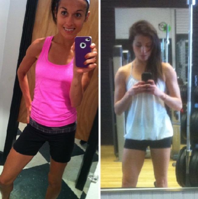 Anorexia Before and After