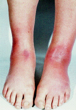 Erythema Nodosum Pictures New Health Advisor Erythema Nodosum Pictures New Health Advisor