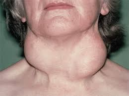 10 Common Endocrine System Disorders
