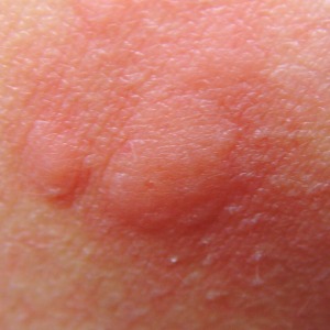 What Does Malaria Look Like on the Skin?