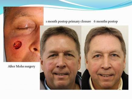 Mohs Surgery Pictures