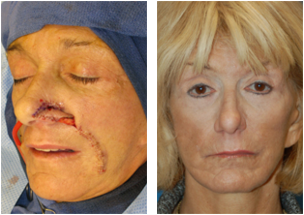 Mohs Surgery Pictures