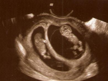 10 Weeks Pregnant with Twins
