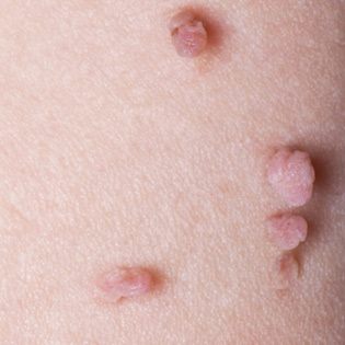 Skin Tags During Pregnancy