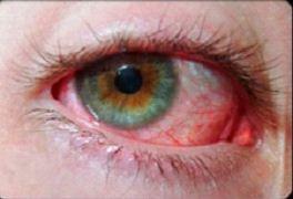How Is Pink Eye Spread?