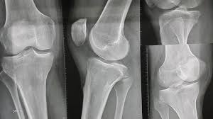Take Care During Tibial Plateau Fracture Recovery