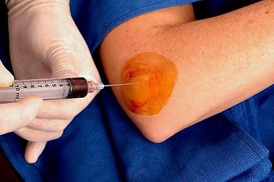 Pain After Cortisone Injection: Why and What to Do.