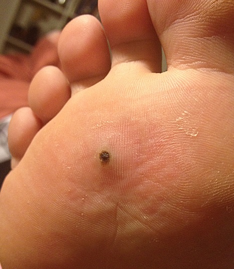 Dark Spots on Bottom of Foot