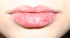 Chapped lips