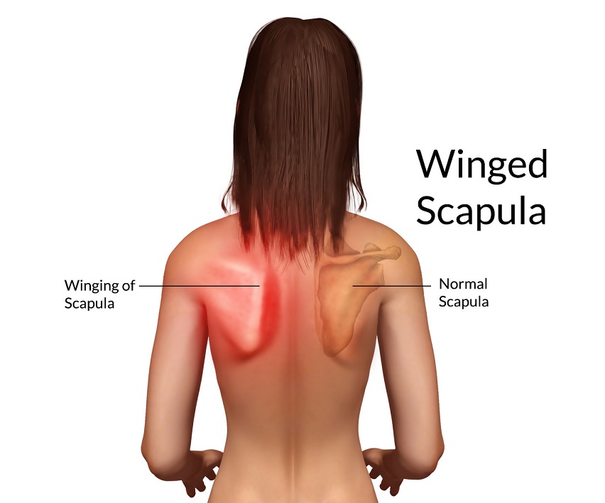 Try 8 Best Winged Scapula Exercises to Help