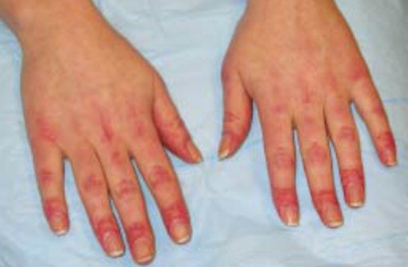 Causes And Treatment Of Small Red Bumps On Hands New Health Advisor