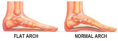 What Causes That Sharp Pain in Arch of Foot?