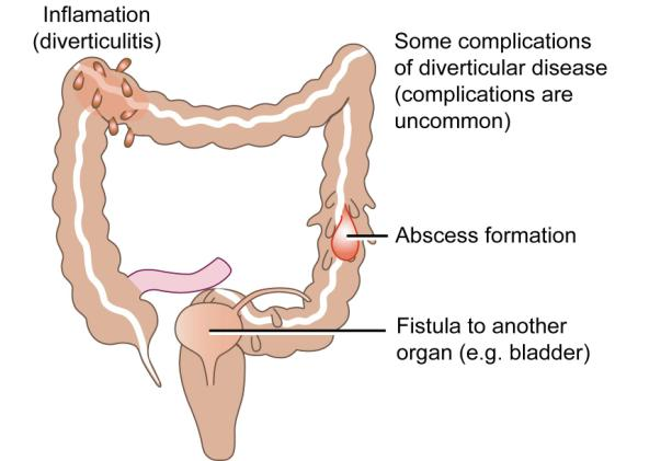 Possible Explanations for Your Burning in Lower Abdomen