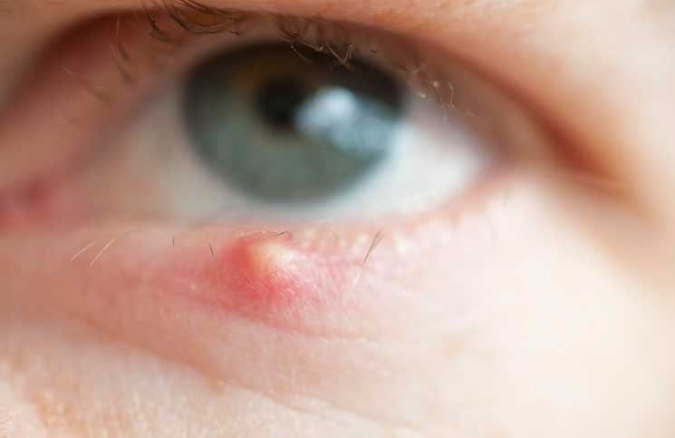How to Prevent a Stye