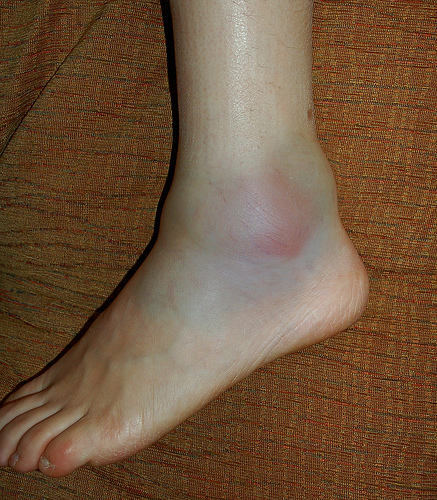 Swollen Ankle