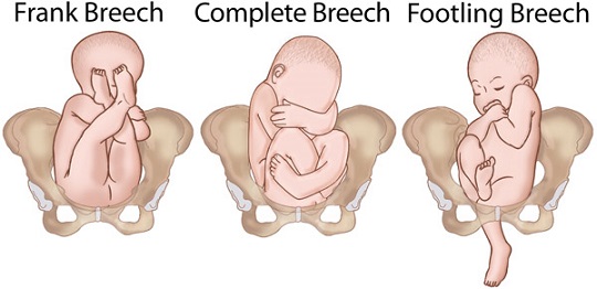 Position of Your Baby at 8 Months Pregnant