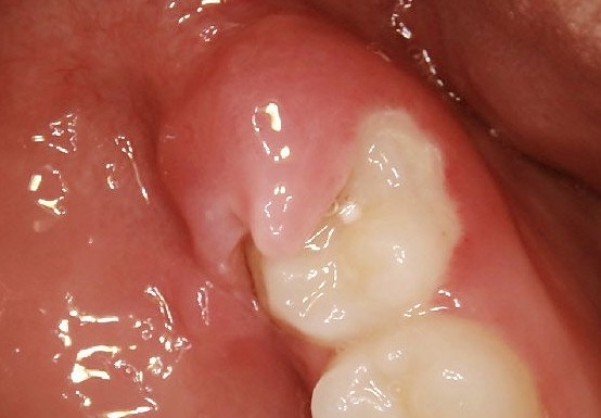 Should I Remove My Partially Erupted Wisdom Tooth?