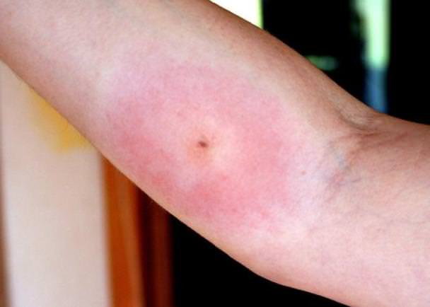 Bug Bite With White Ring Around It Tsmp Medical Blog Tsmp Medical Blog