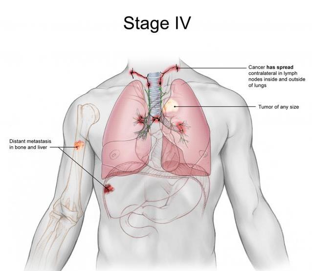 Last-Stage Lung Cancer: Sign, Treatment And Life Expectancy | New Health  Advisor