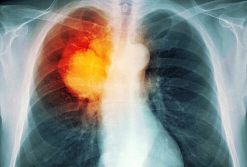 Symptoms of Lung Cancer and When to See a Doctor