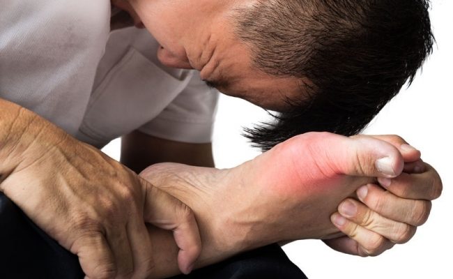 Gout Symptoms and Effective Managing Measures