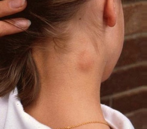 Possible Causes of Lump on the Side of Neck