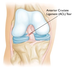 Can You Walk with a Torn ACL?