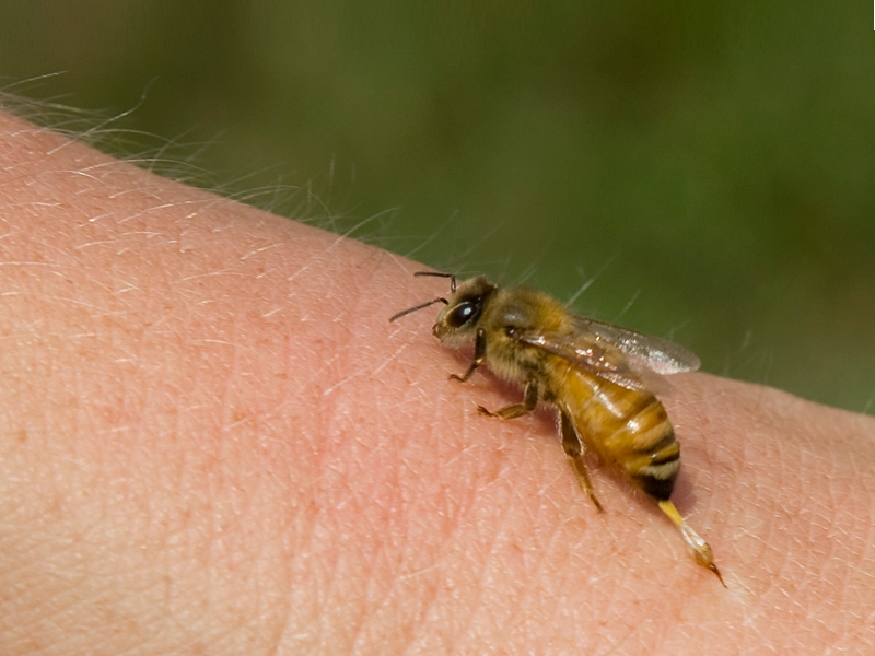 First Aid for 5 Common Bites and Stings