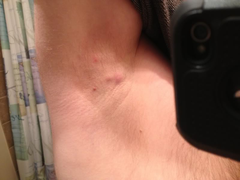 Armpit Swollen Lymph Nodes