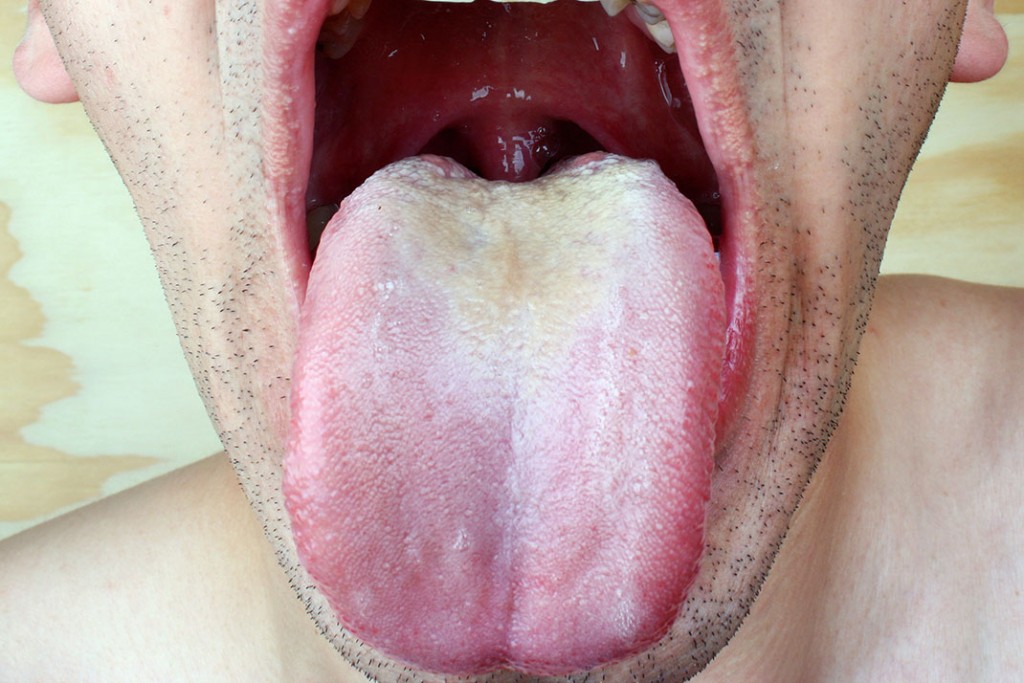 Foods You Should Avoid When Having Oral Thrush