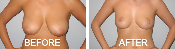Drawing Breast Reduction Needed
