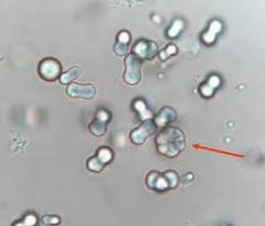 Crystal in the Urine: Symptoms, Types and Treatments