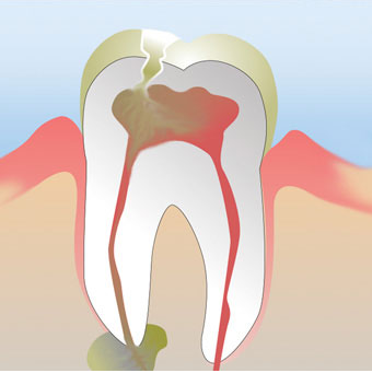 tooth abscess