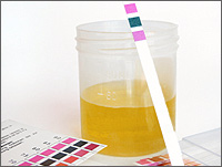 Normal Urinalysis Results and Clinical Implications | New Health Advisor